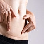 Scar revision or removal surgery 101: what you need to know