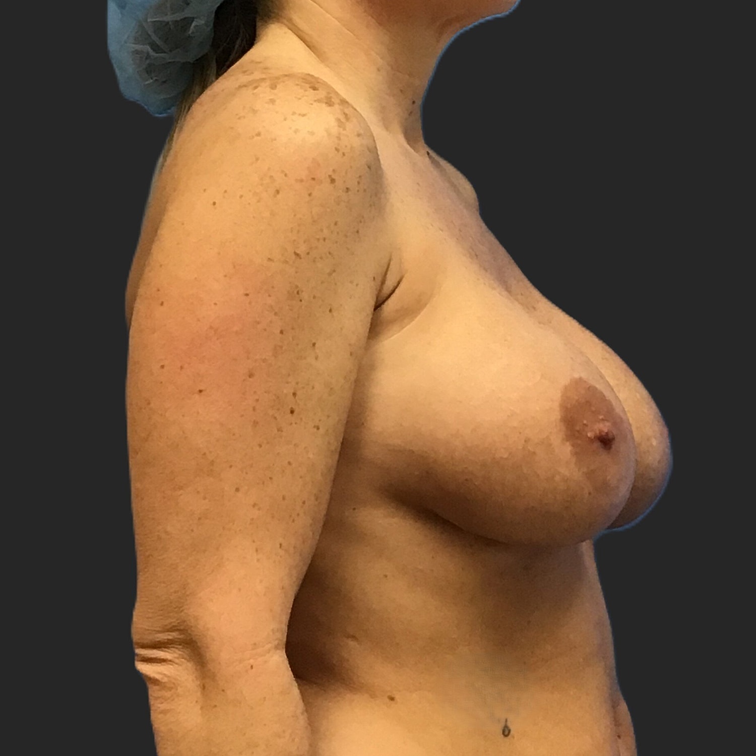 Breast Implant Revision Before & After