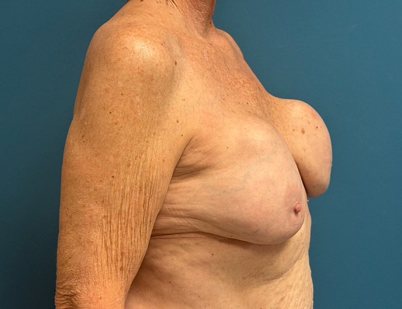 Breast Implant Revision Before & After