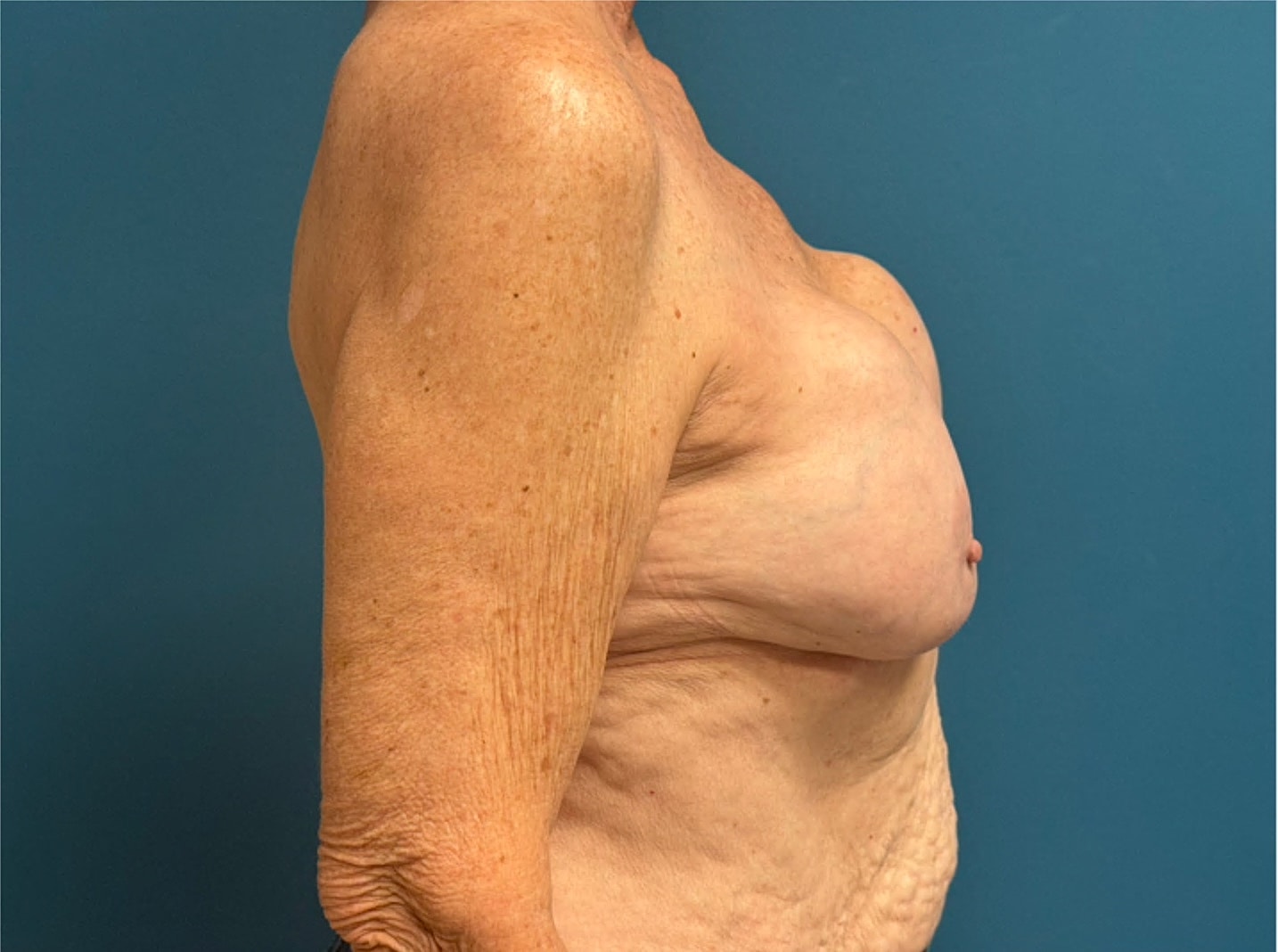 Breast Implant Revision Before & After
