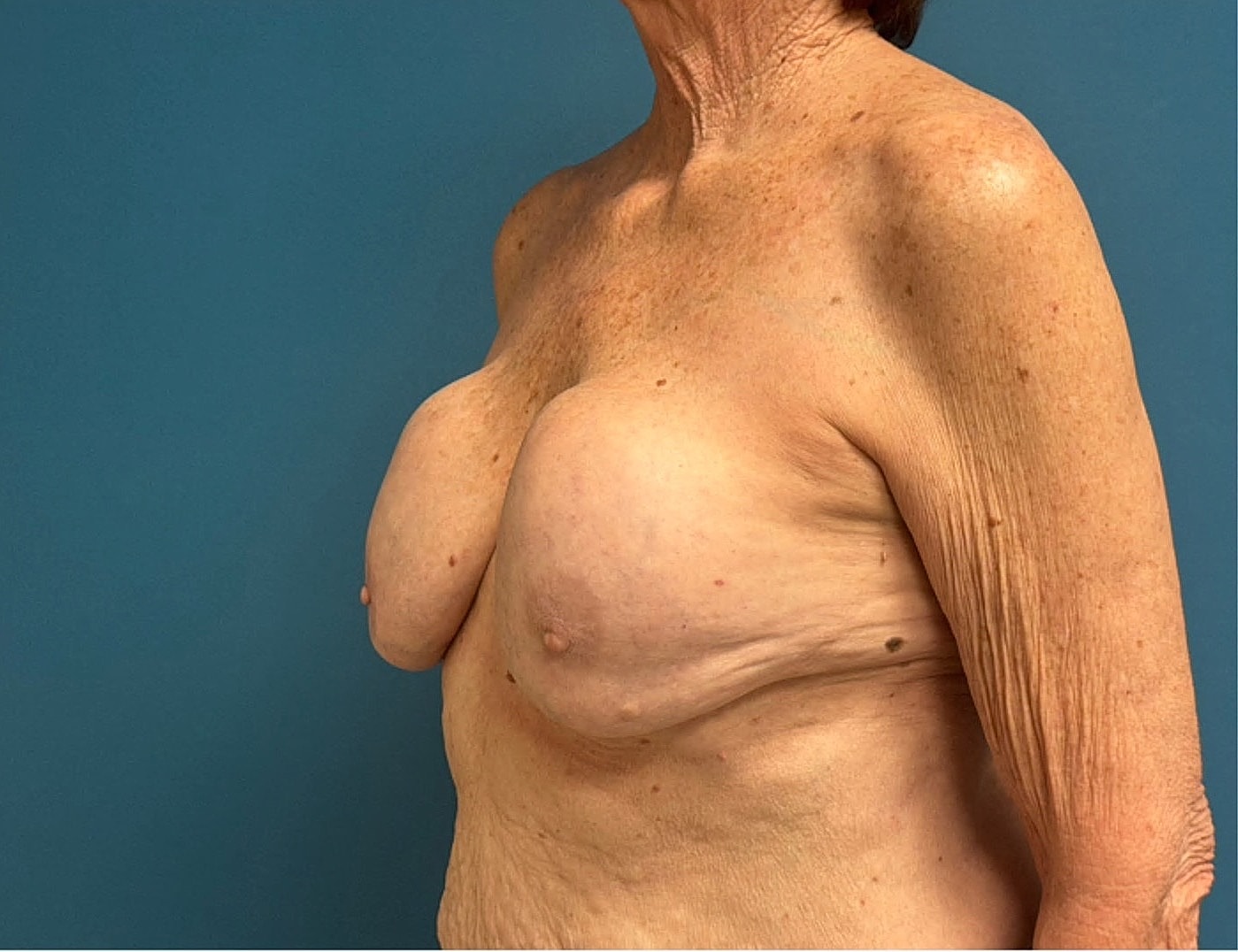 Breast Implant Revision Before & After