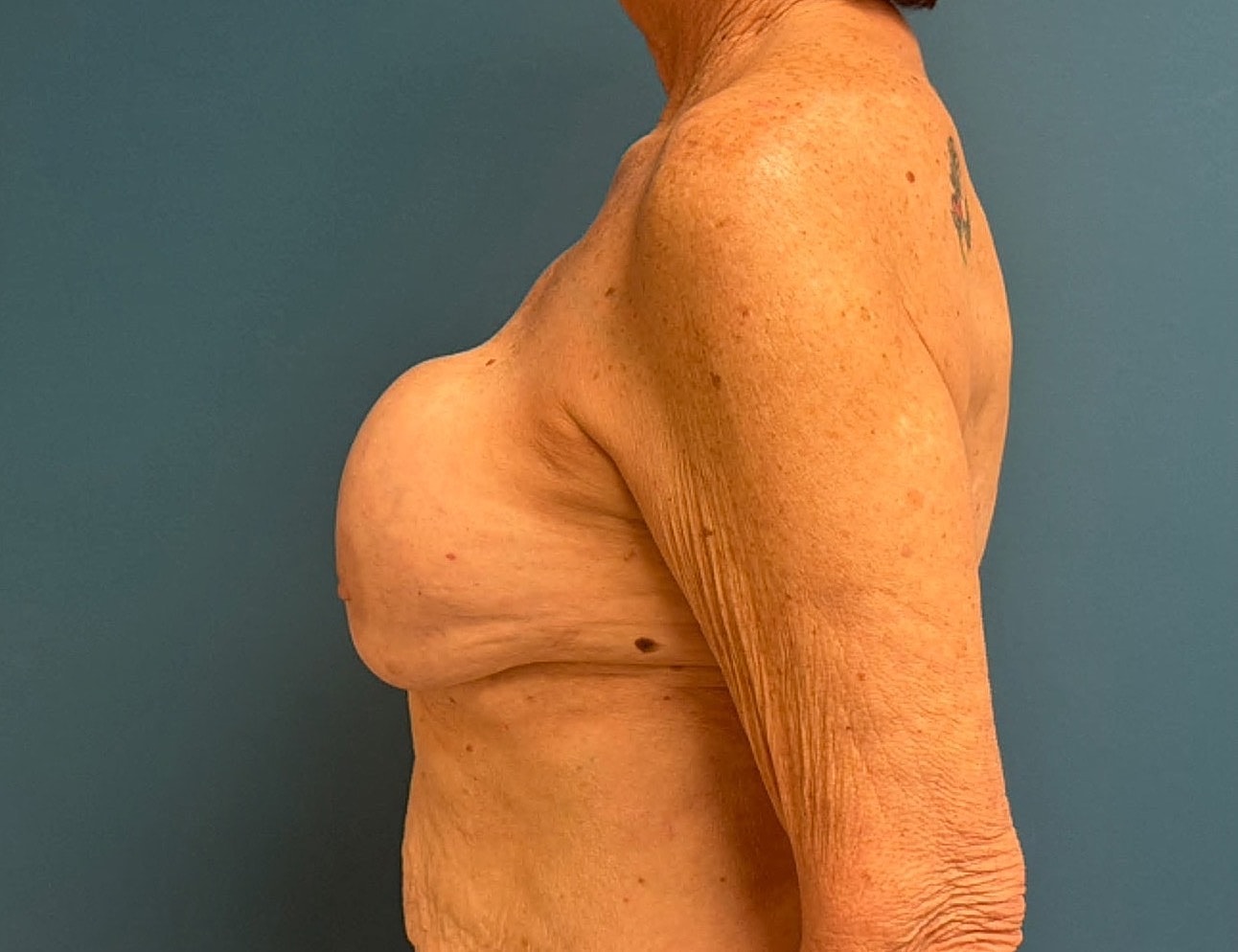 Breast Implant Revision Before & After