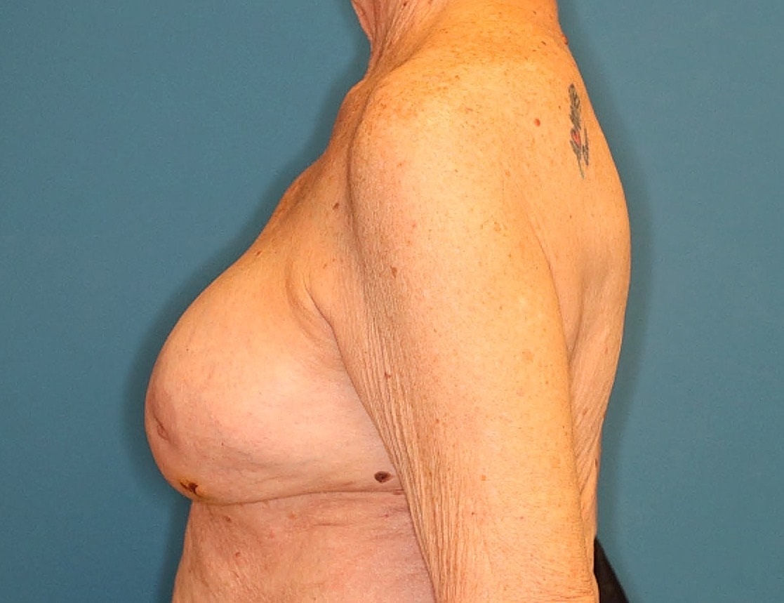 Breast Implant Revision Before & After