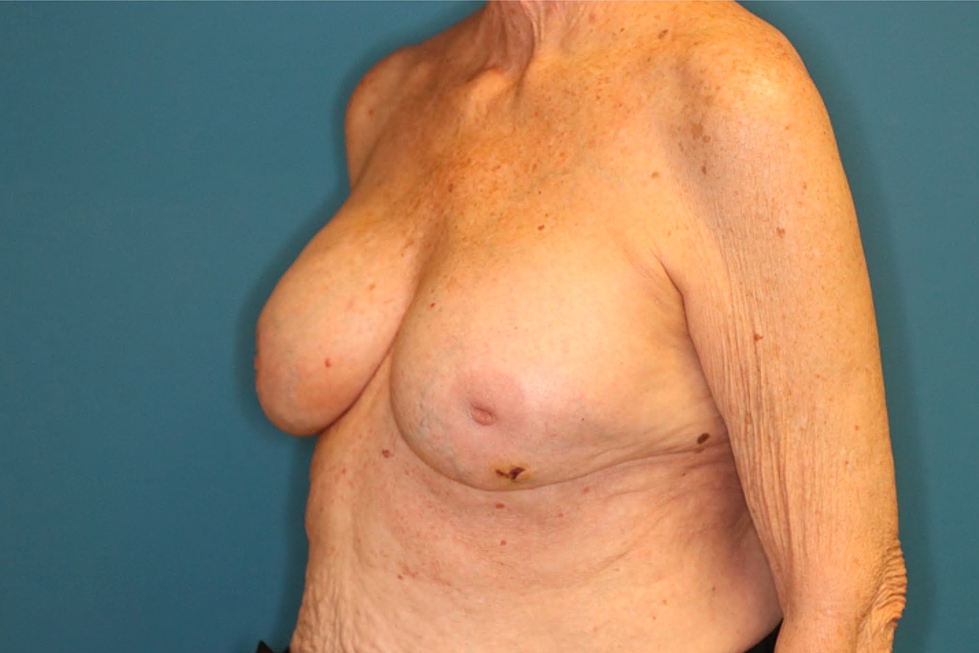 Breast Implant Revision Before & After