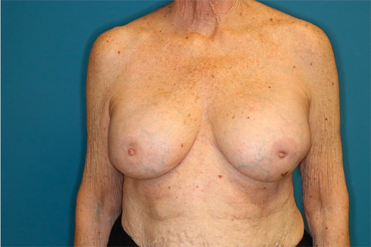 Breast Implant Revision Before & After