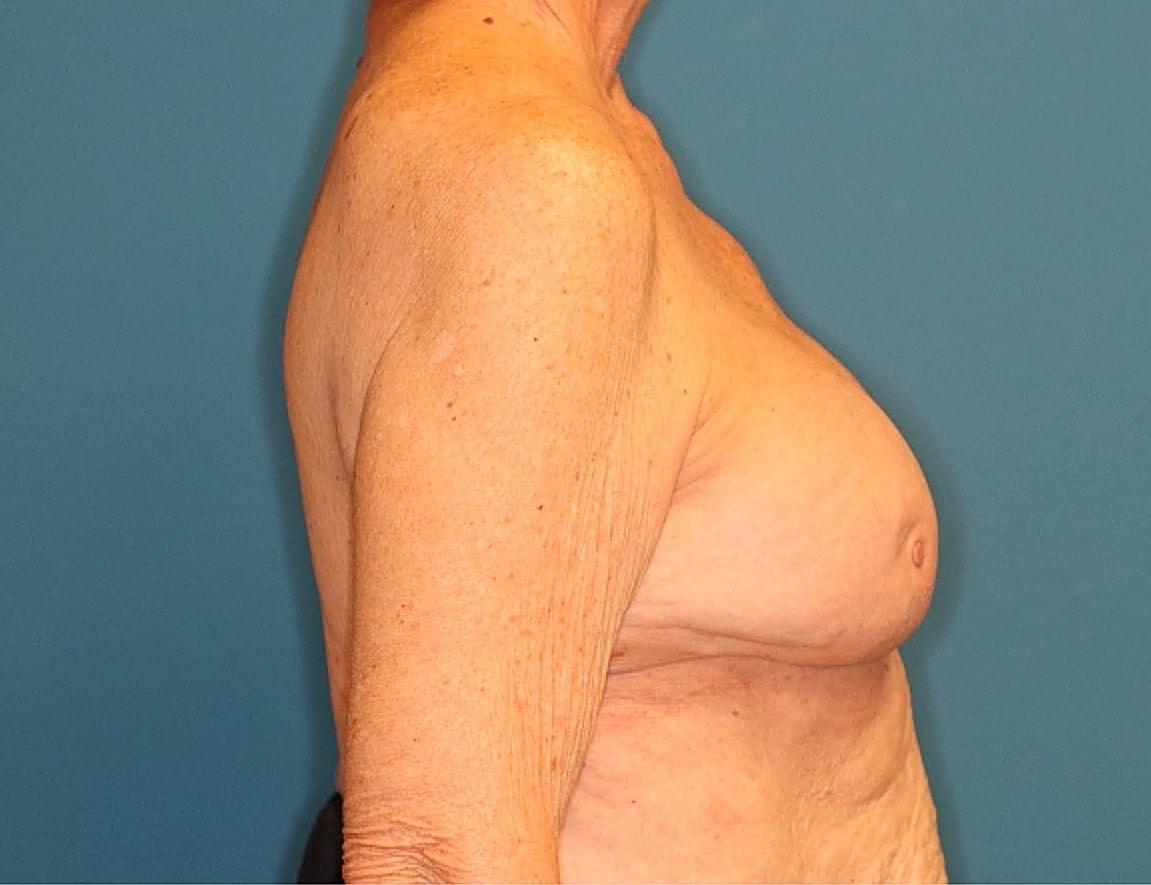 Breast Implant Revision Before & After