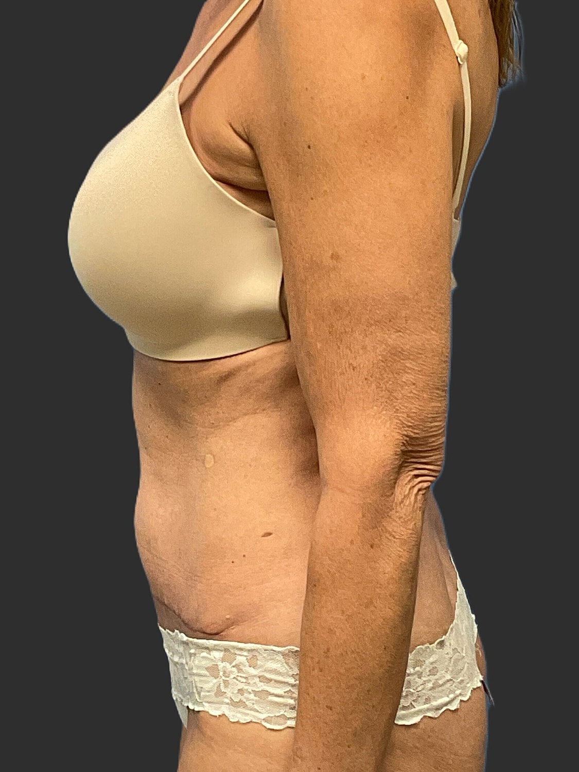 Mini Tummy Tuck Before & After