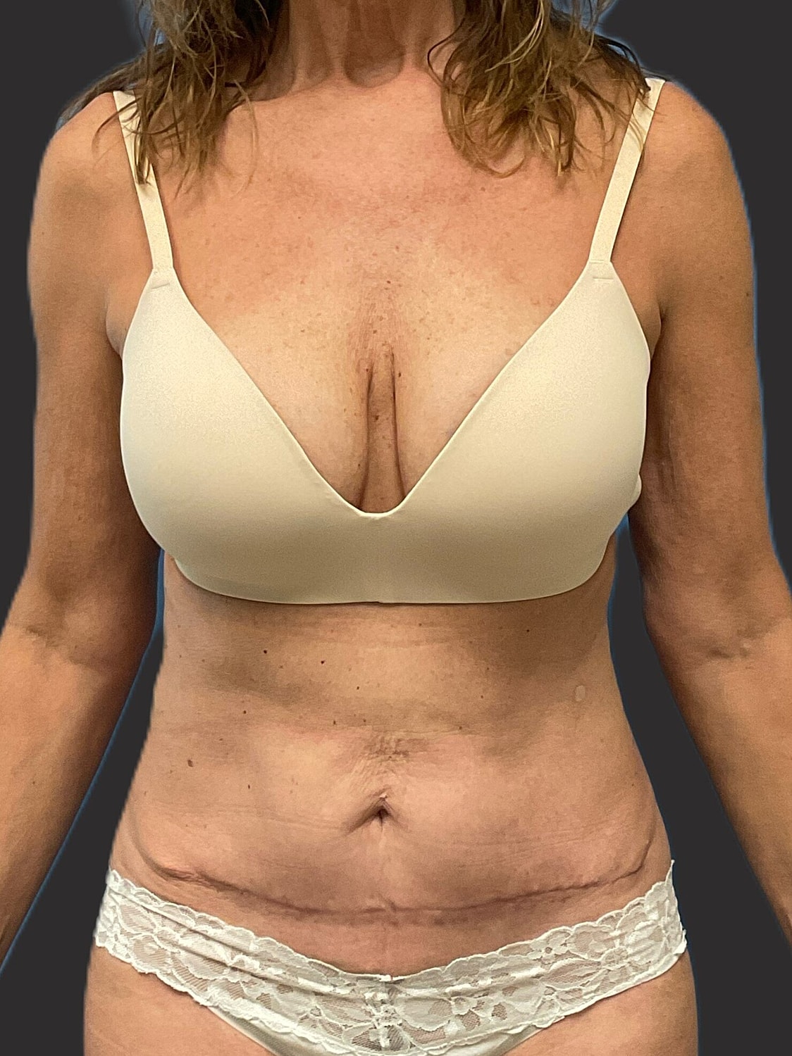 Mini Tummy Tuck Before & After
