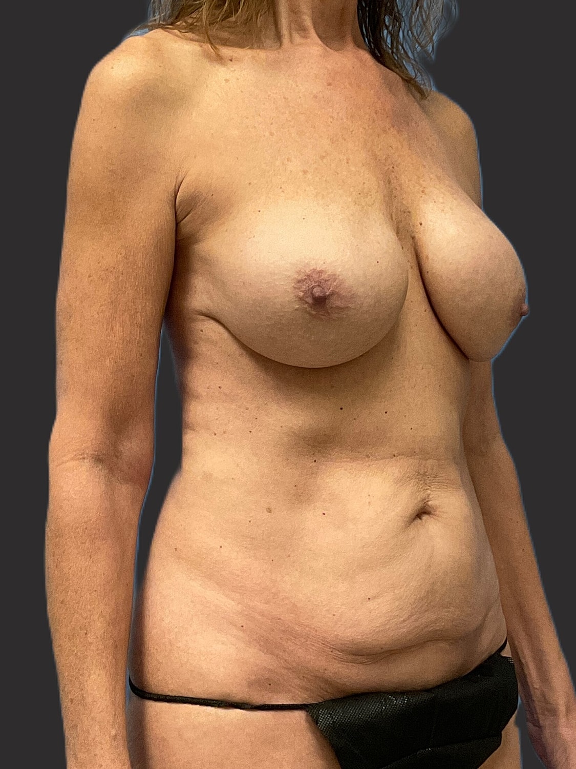 Mini Tummy Tuck Before & After