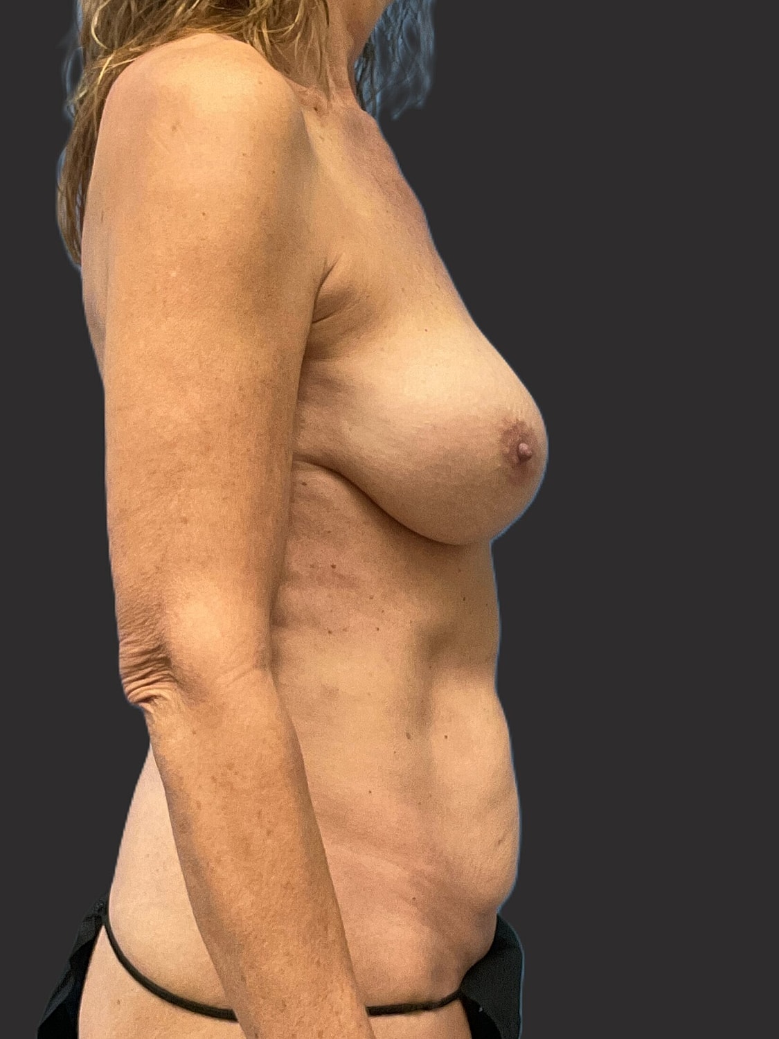 Mini Tummy Tuck Before & After
