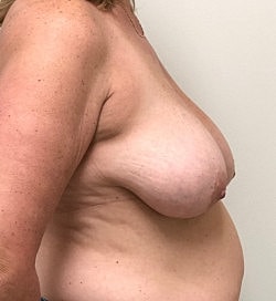 Breast Lift Before & After