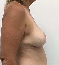 Breast Lift Before & After