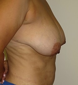 Breast Lift Before & After
