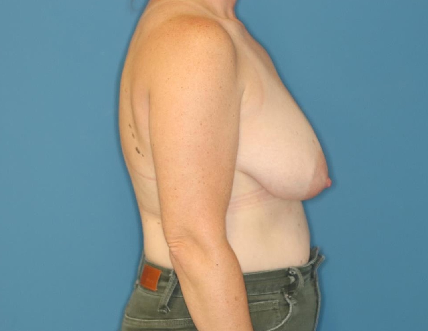 Breast Lift Before & After