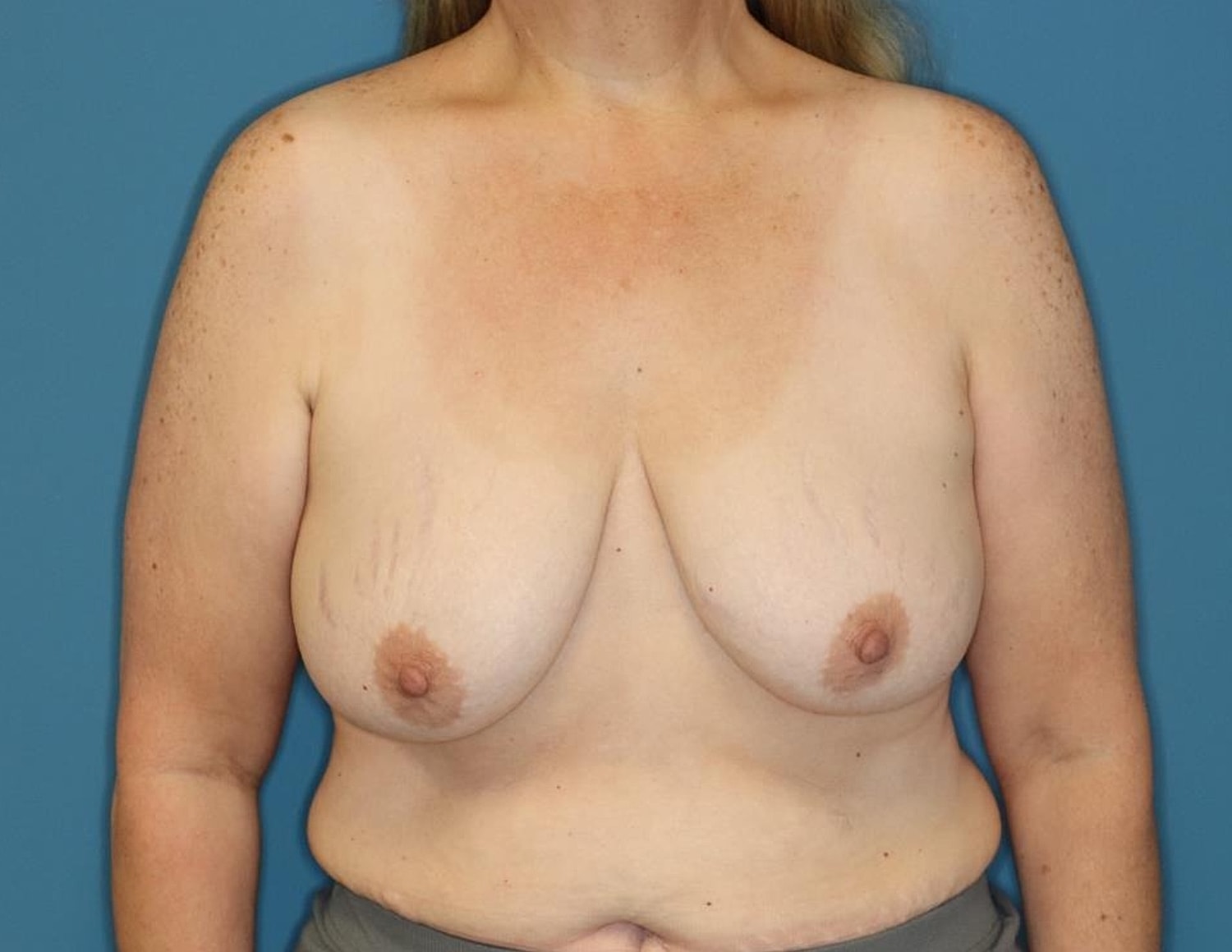 Breast Lift Before & After