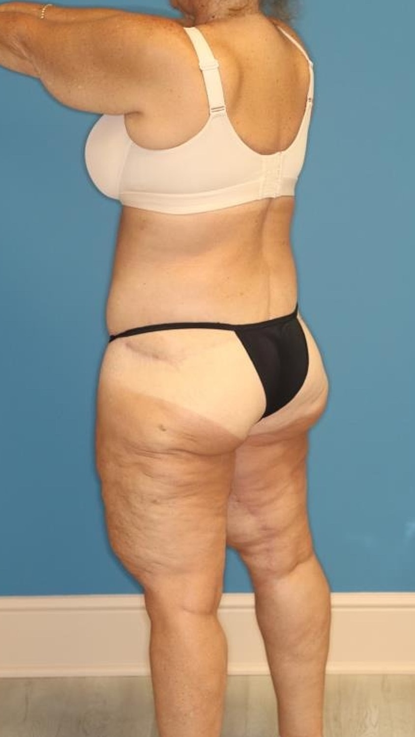 Body Lift Before & After