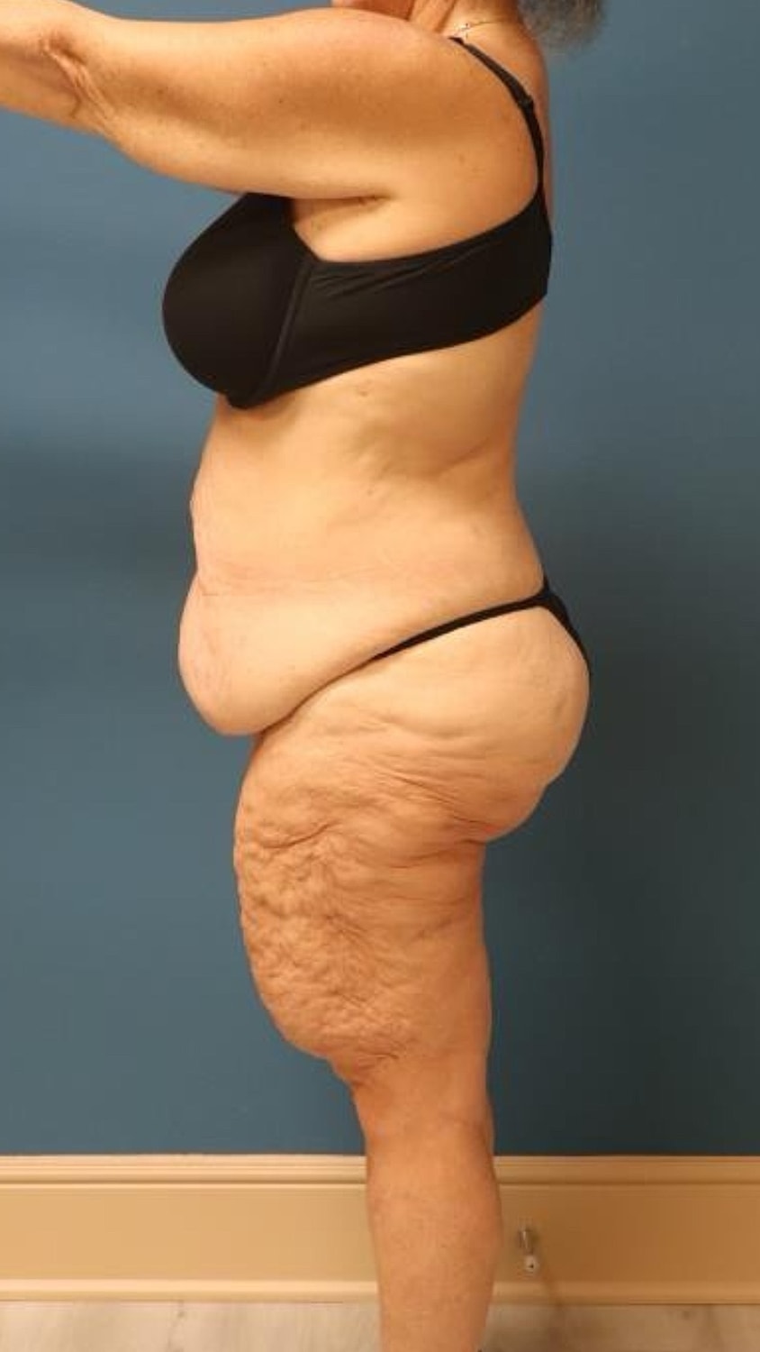 Body Lift Before & After