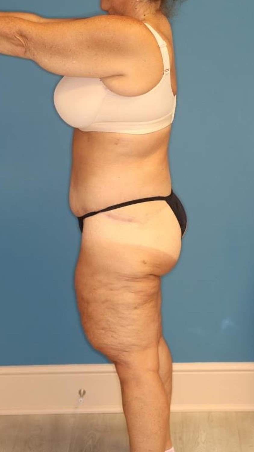 Body Lift Before & After
