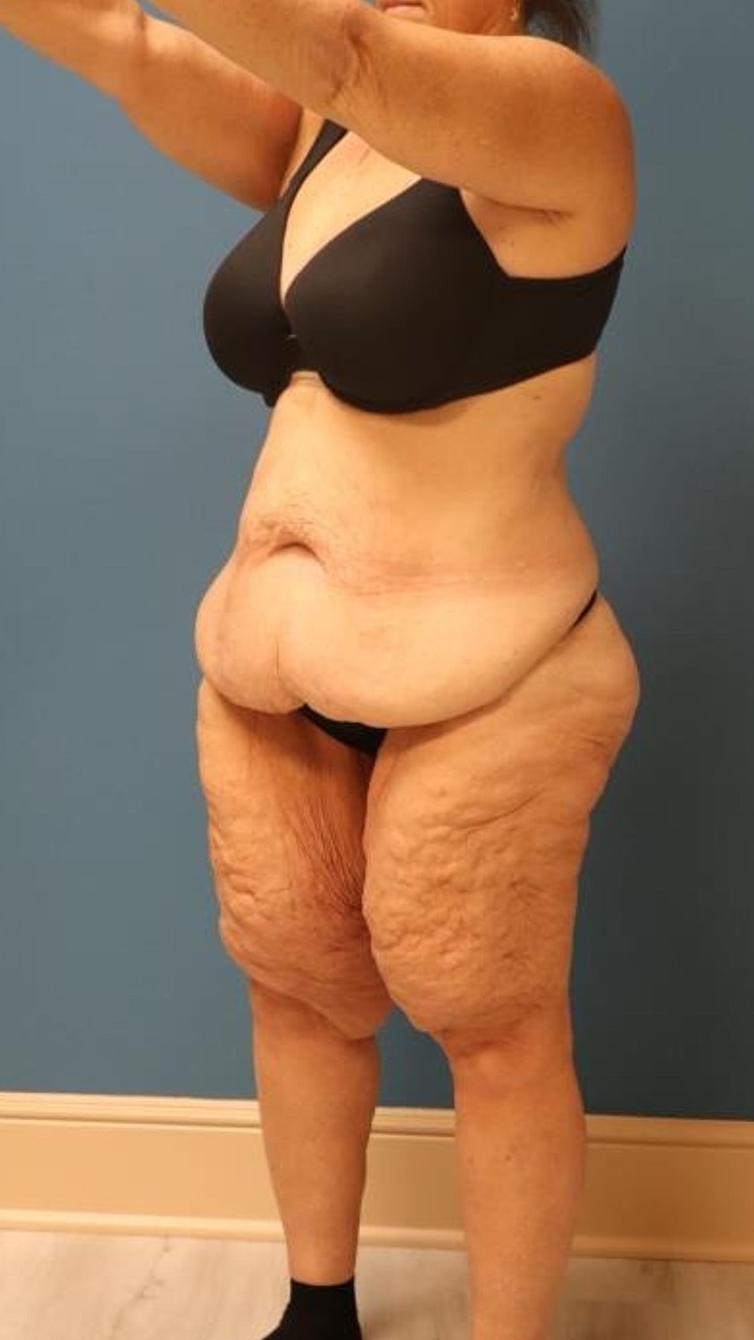Body Lift Before & After