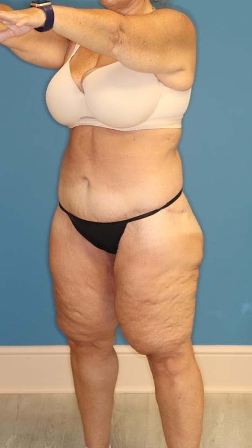 Body Lift Before & After