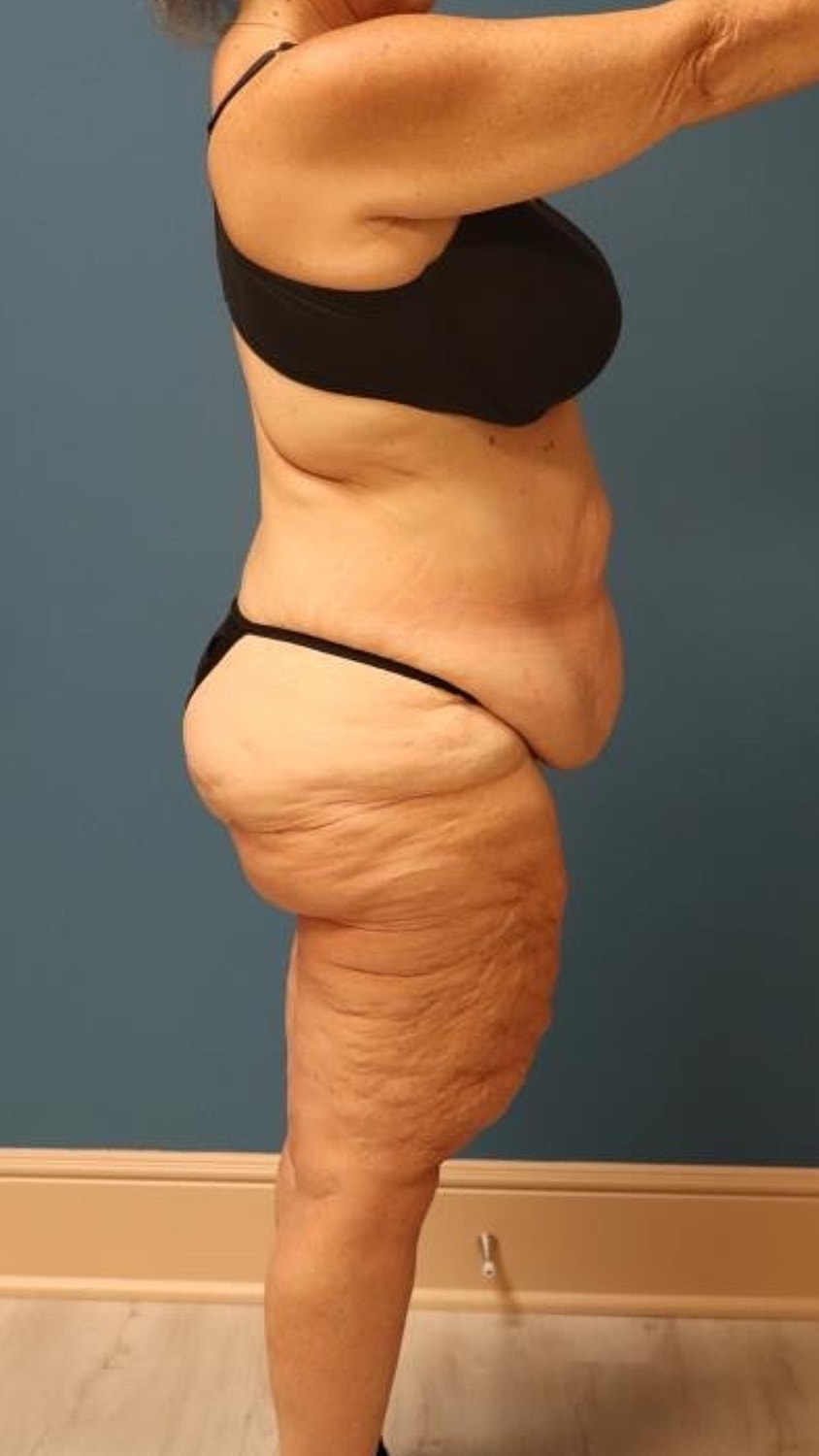 Body Lift Before & After