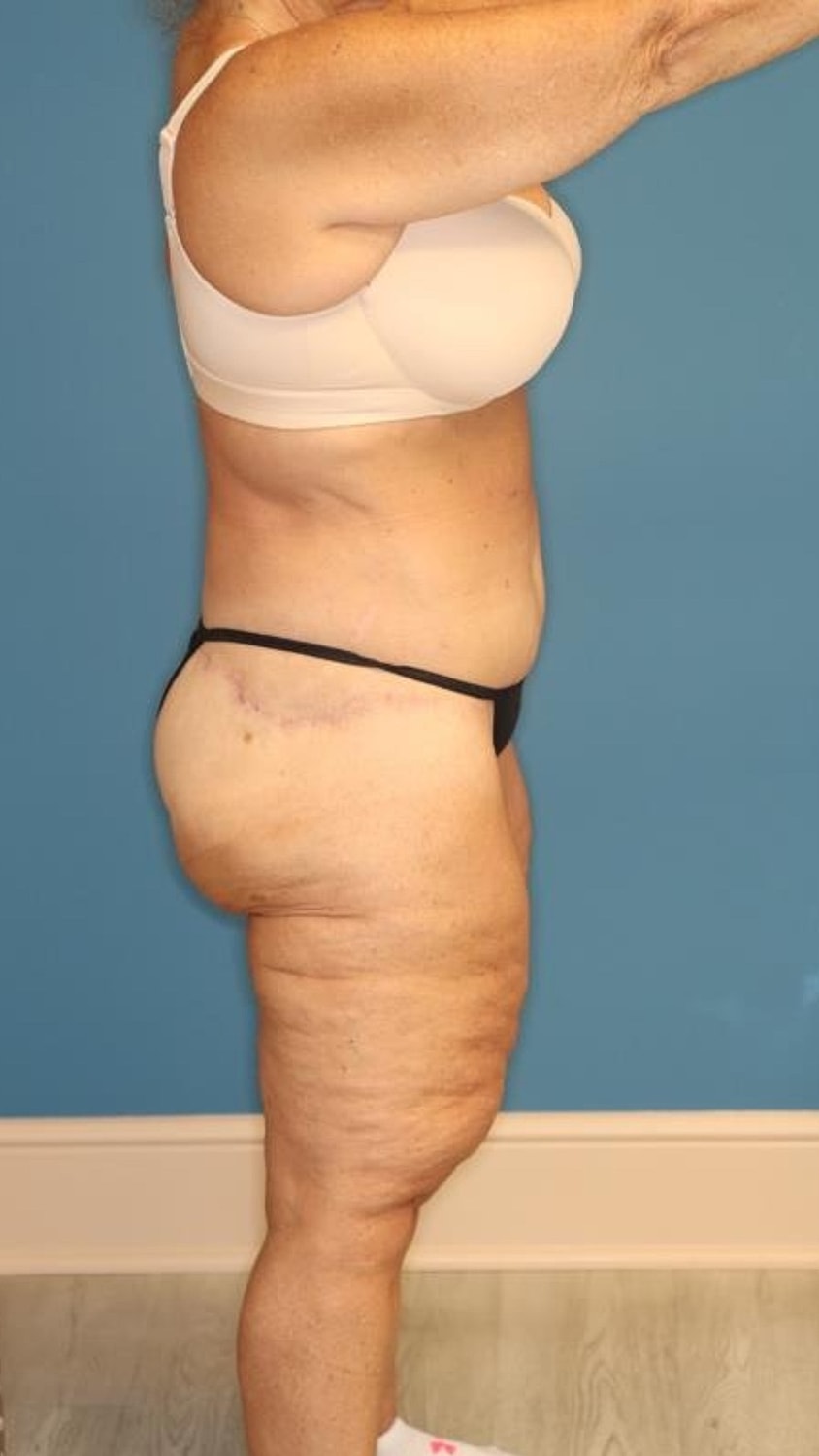 Body Lift Before & After
