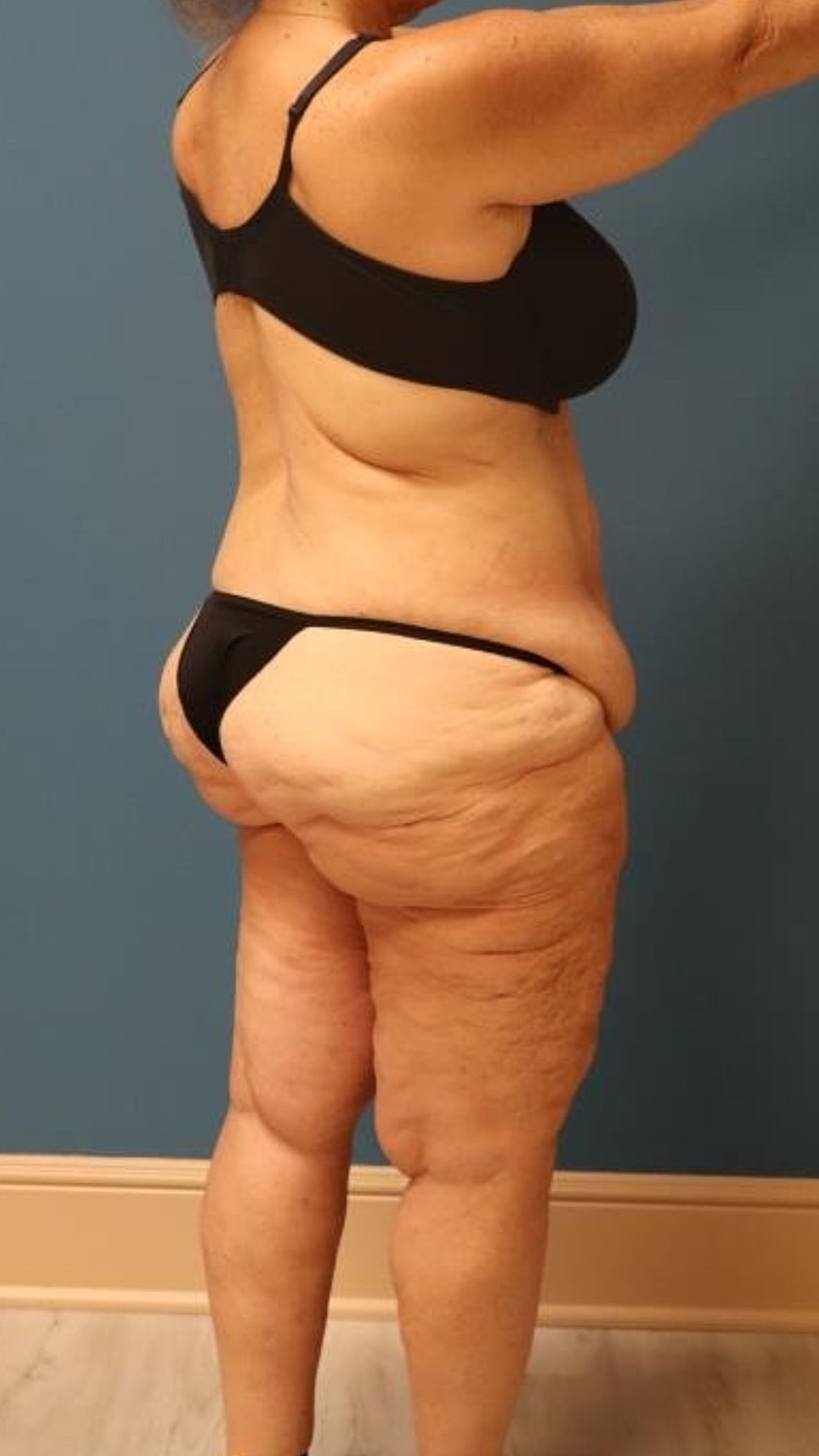 Body Lift Before & After