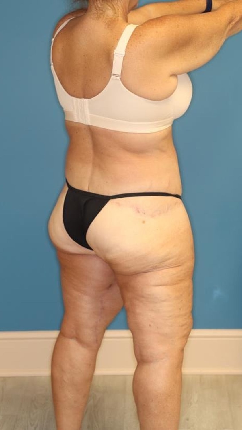 Body Lift Before & After