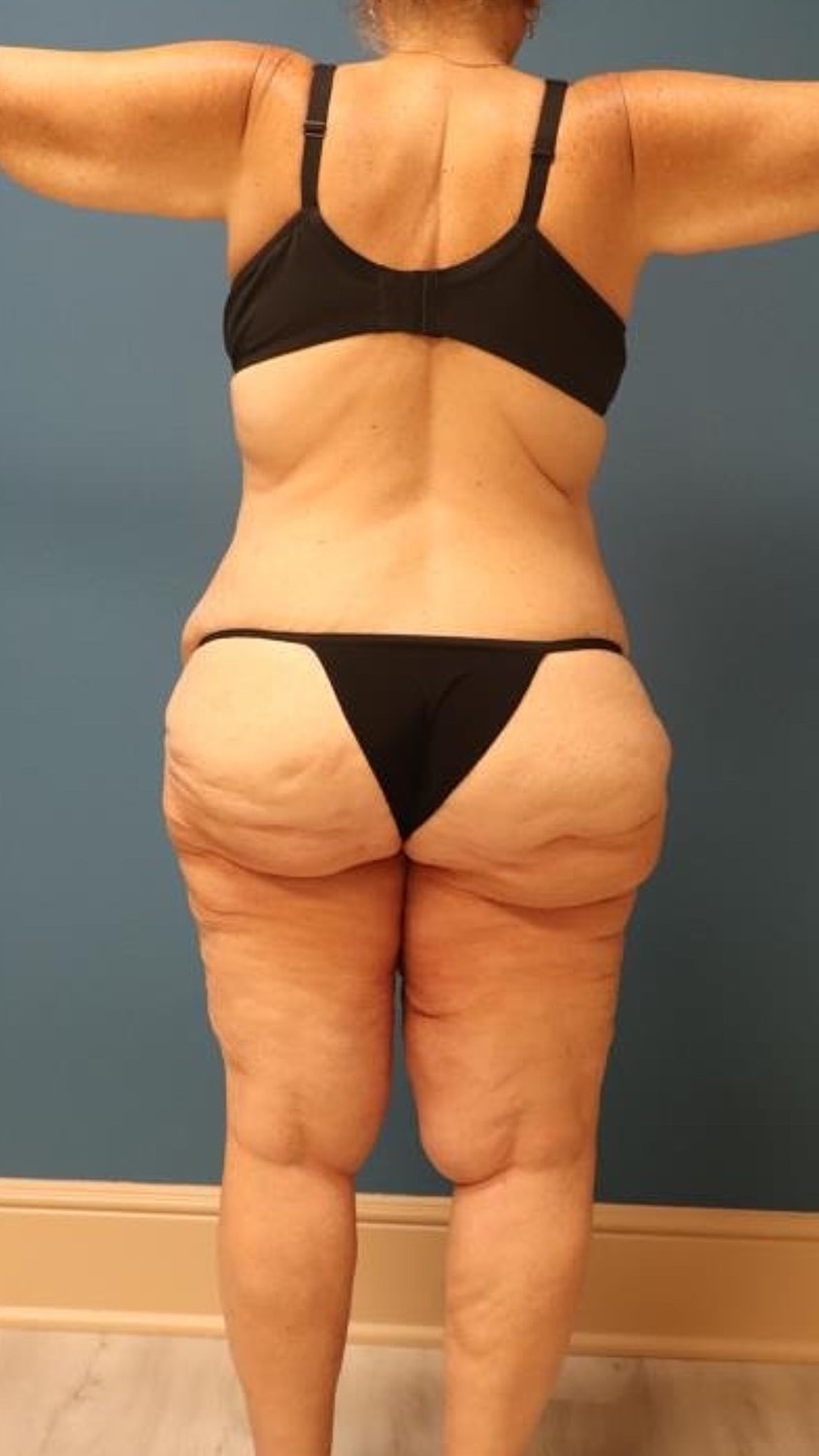 Body Lift Before & After