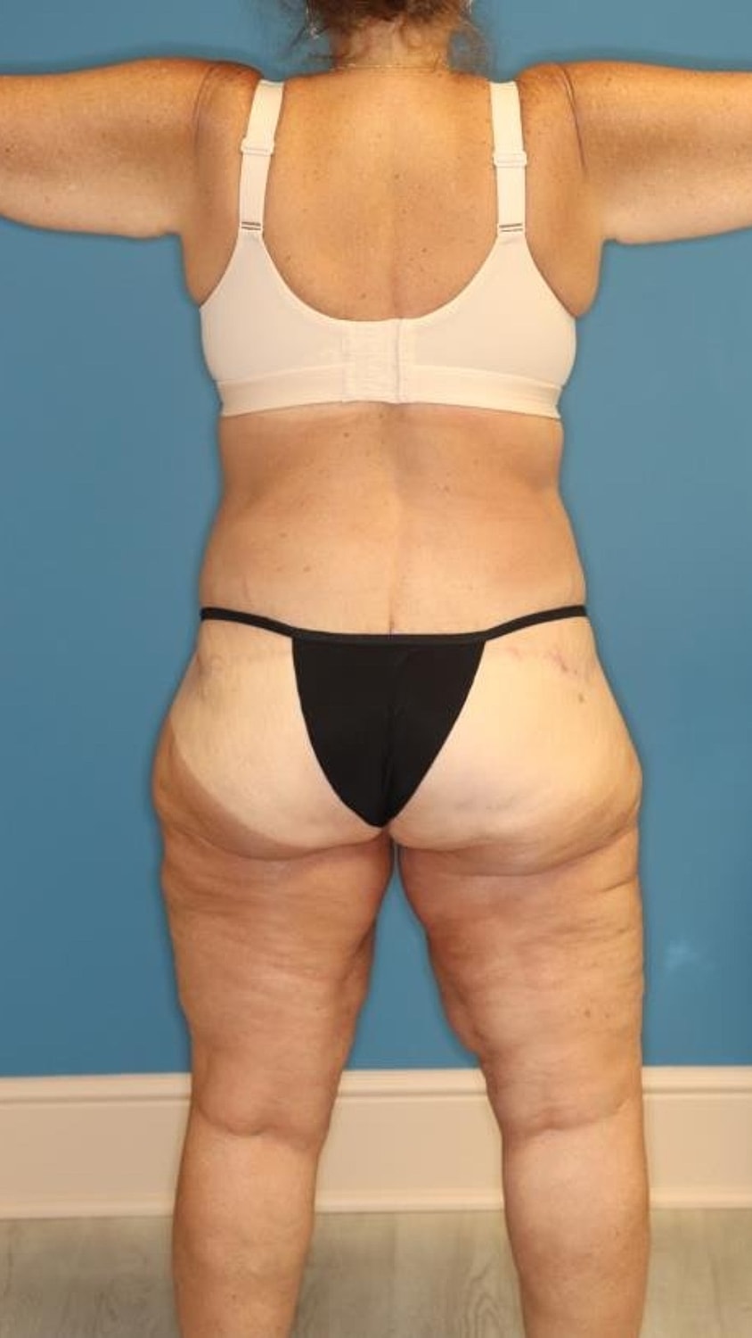 Body Lift Before & After