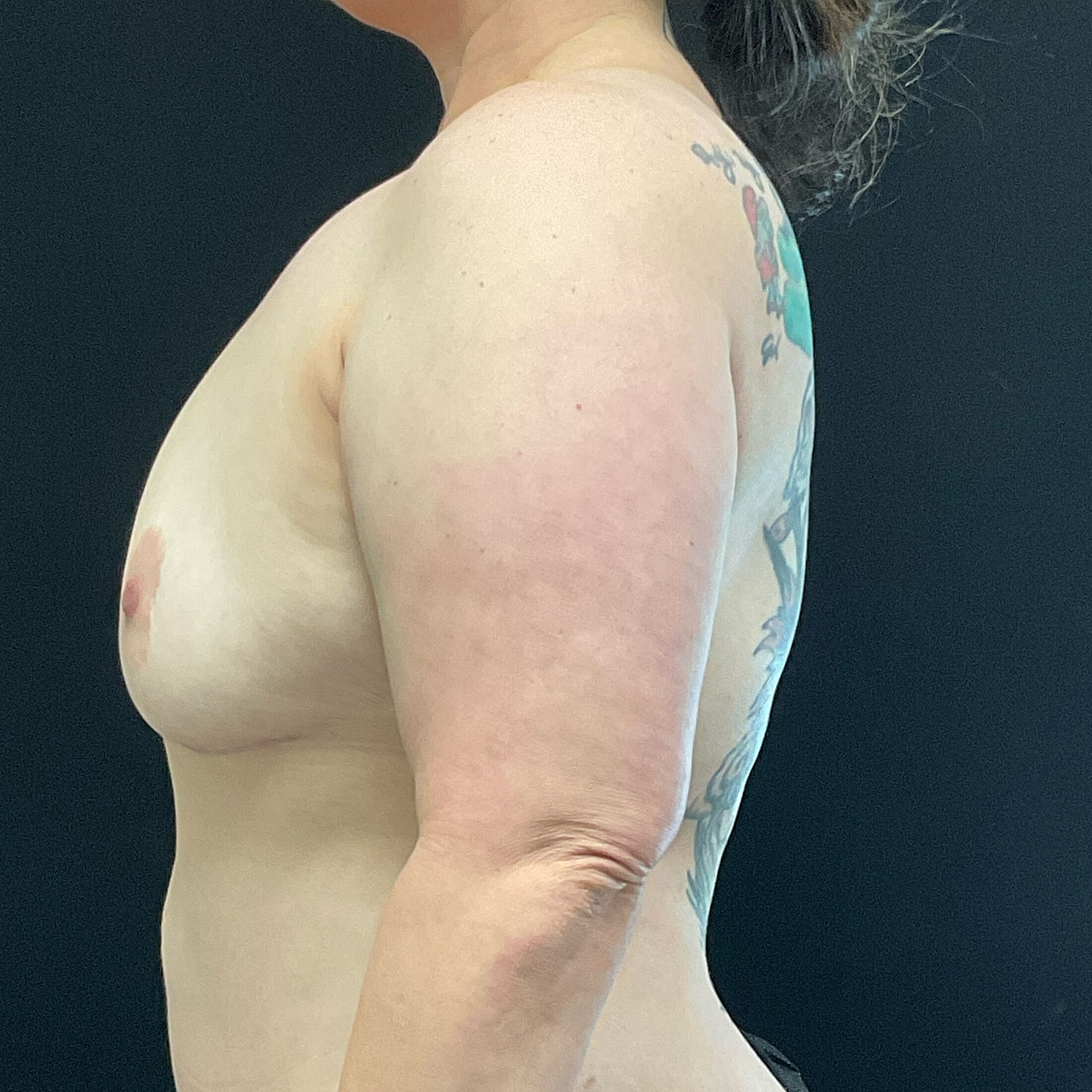 Breast Implant Removal Before & After