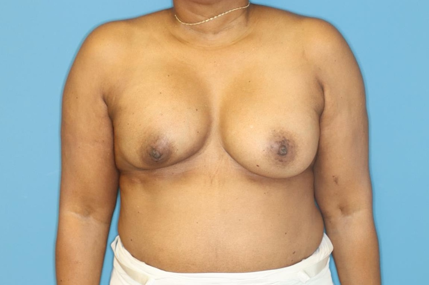 Breast Implant Removal Before & After