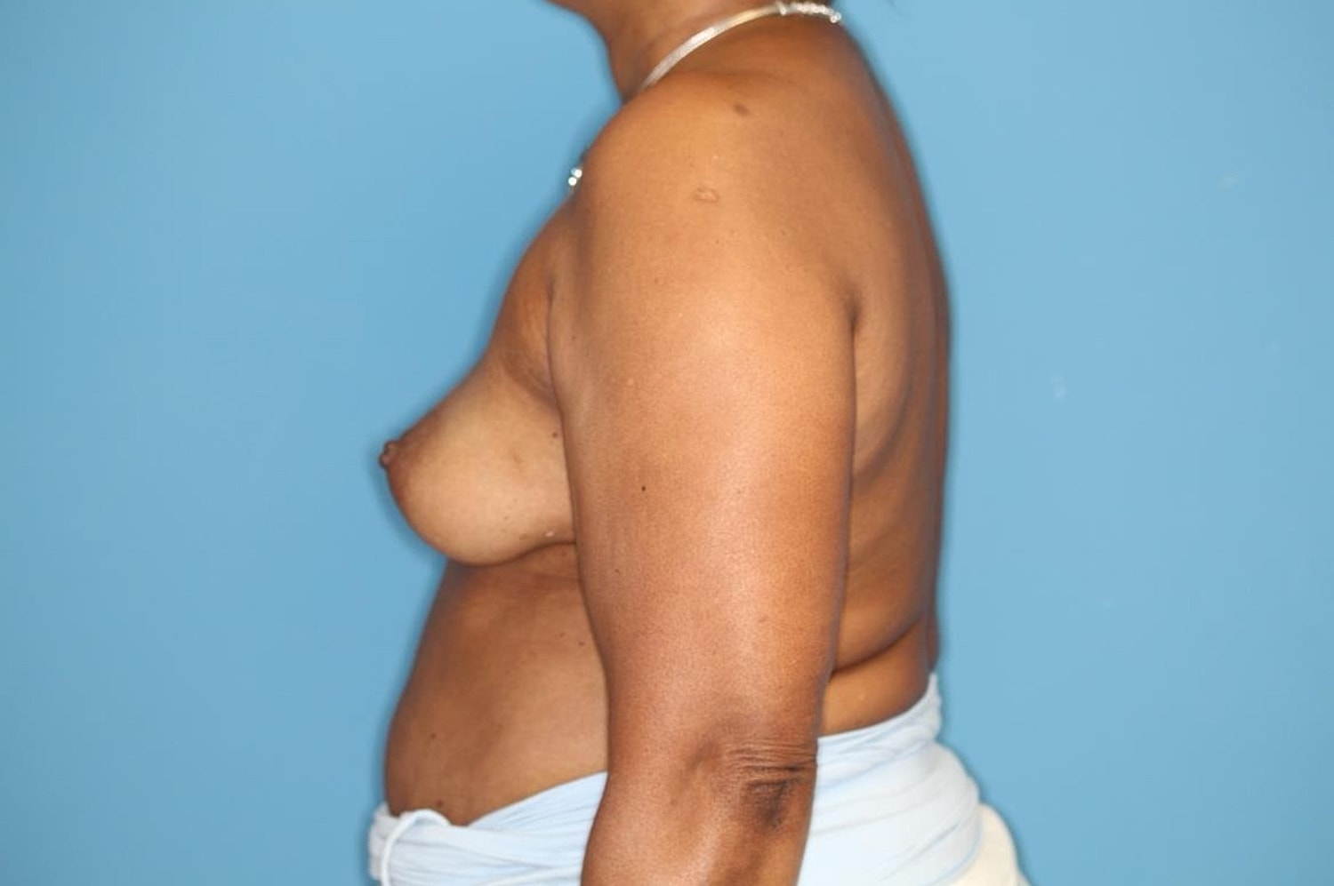 Breast Implant Removal Before & After