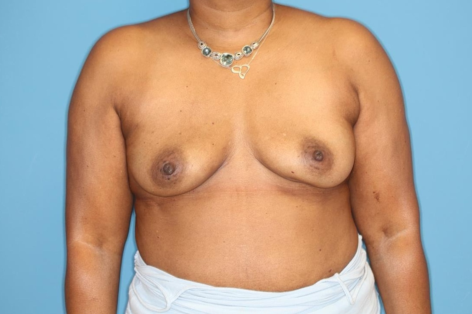 Breast Implant Removal Before & After