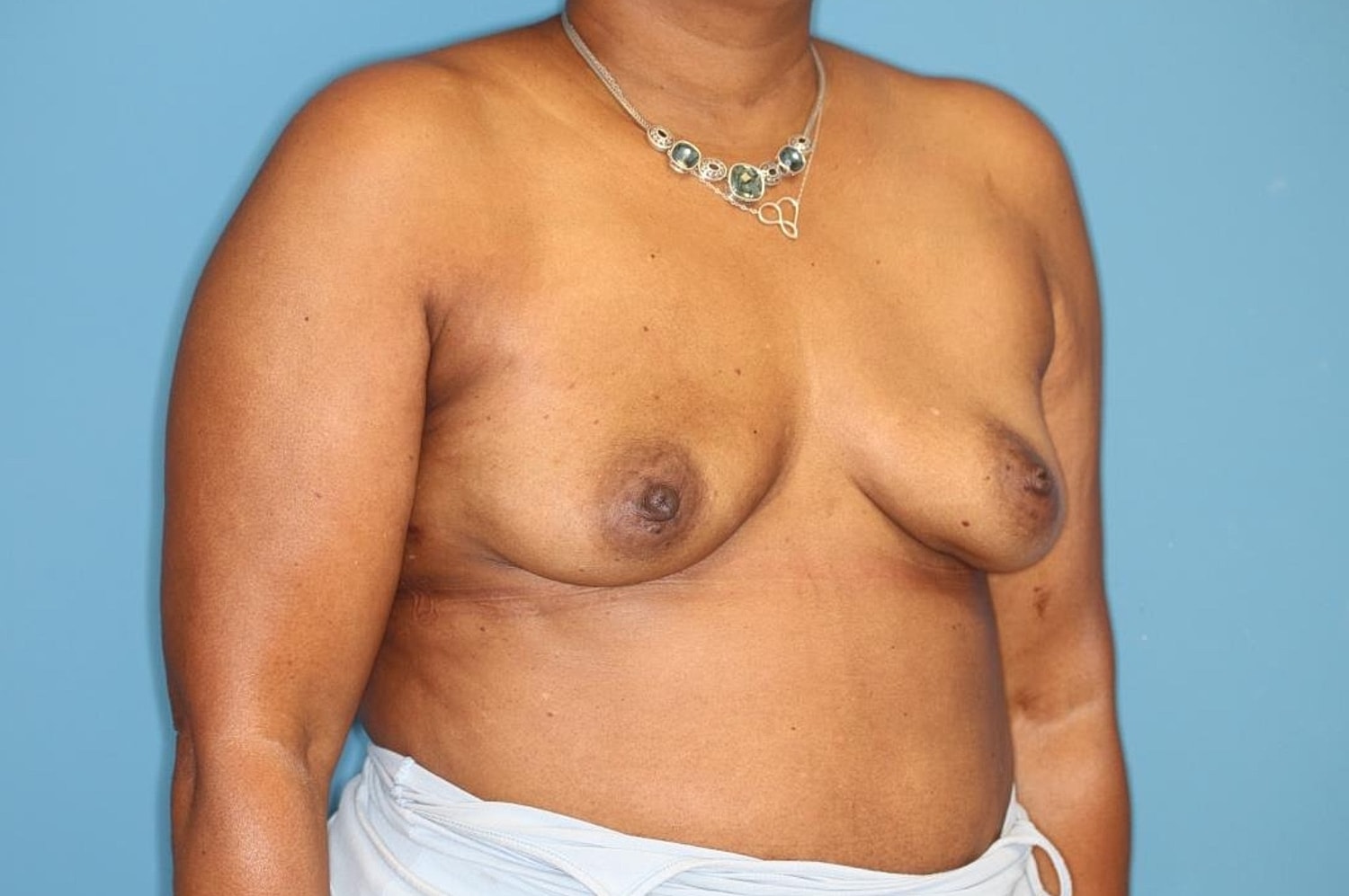 Breast Implant Removal Before & After
