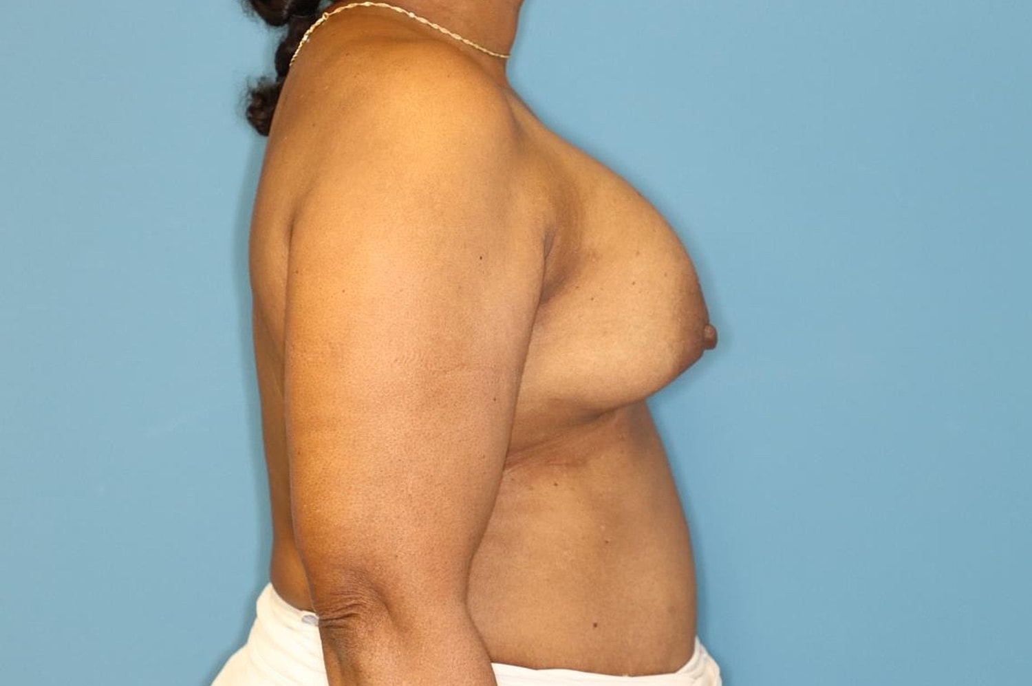 Breast Implant Removal Before & After