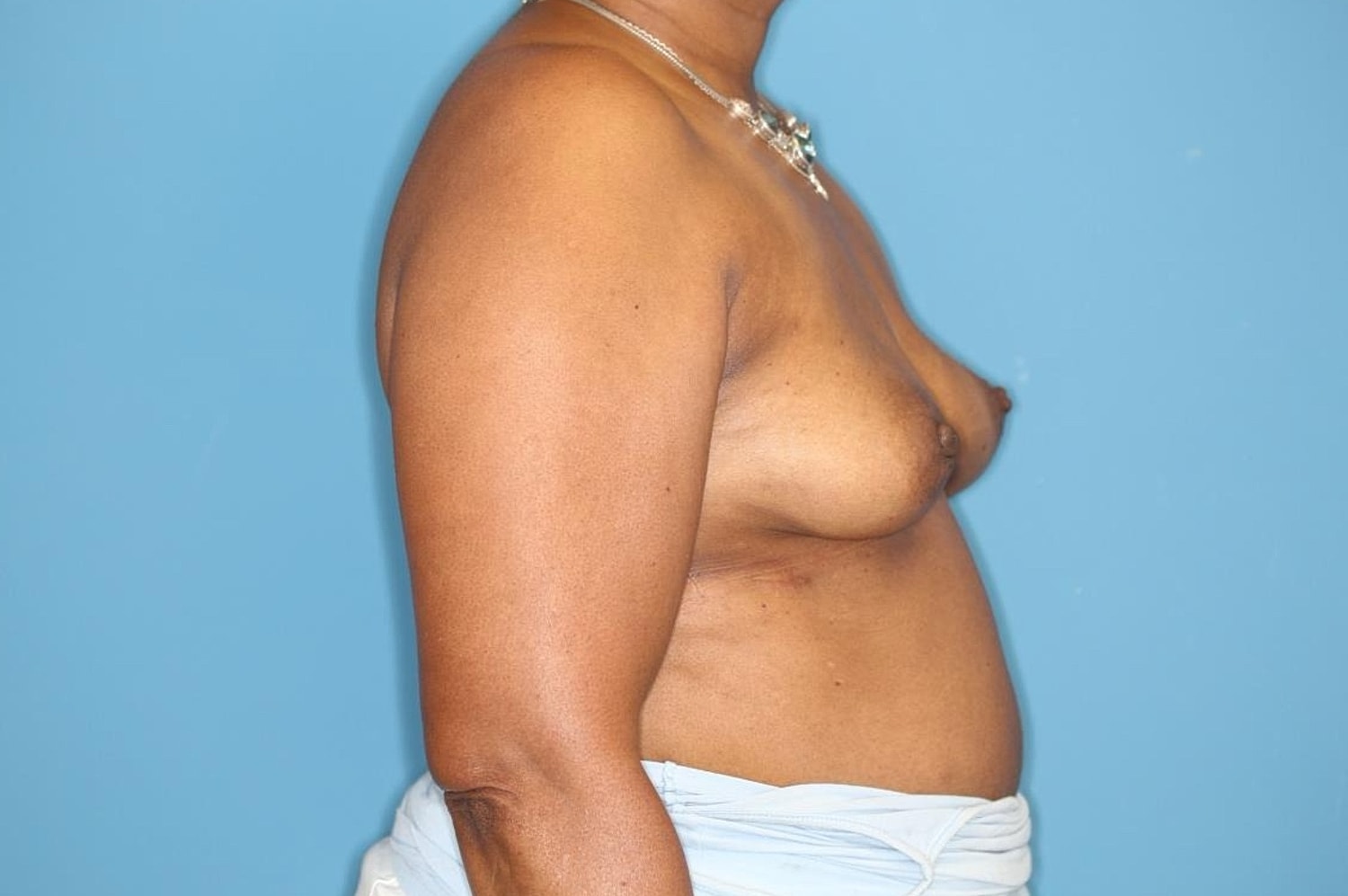 Breast Implant Removal Before & After