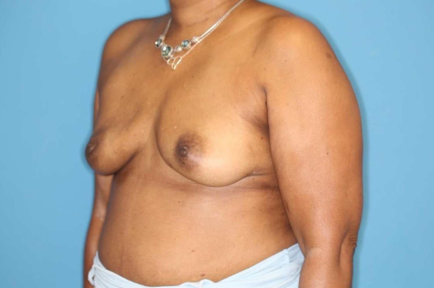 Breast Implant Removal Before & After