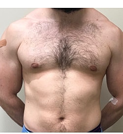 Gynecomastia Surgery Before & After