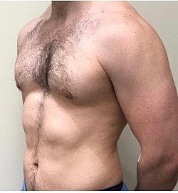 Gynecomastia Surgery Before & After