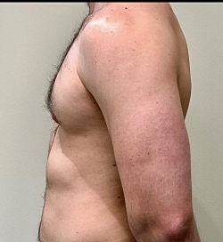 Gynecomastia Surgery Before & After