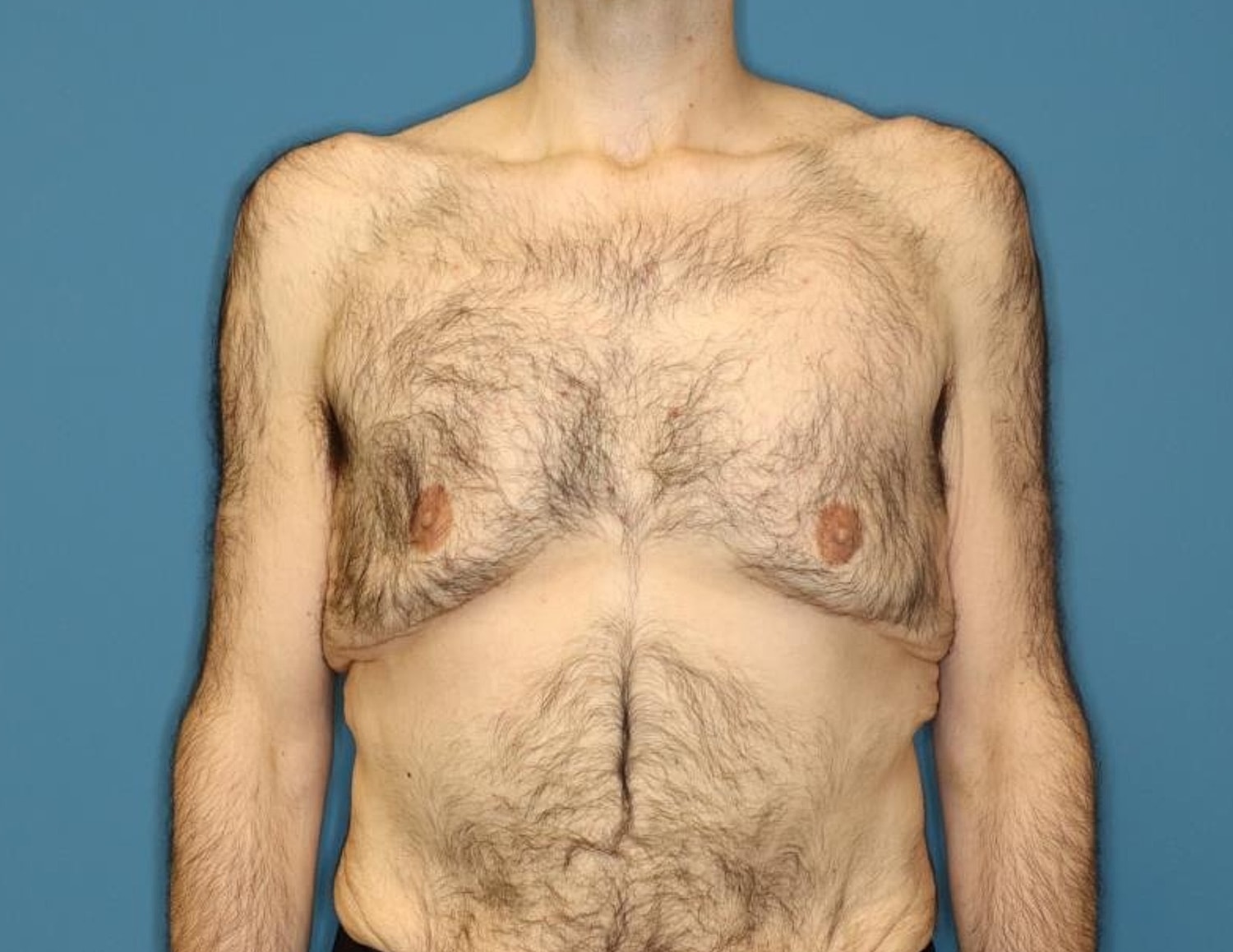 Gynecomastia Surgery Before & After