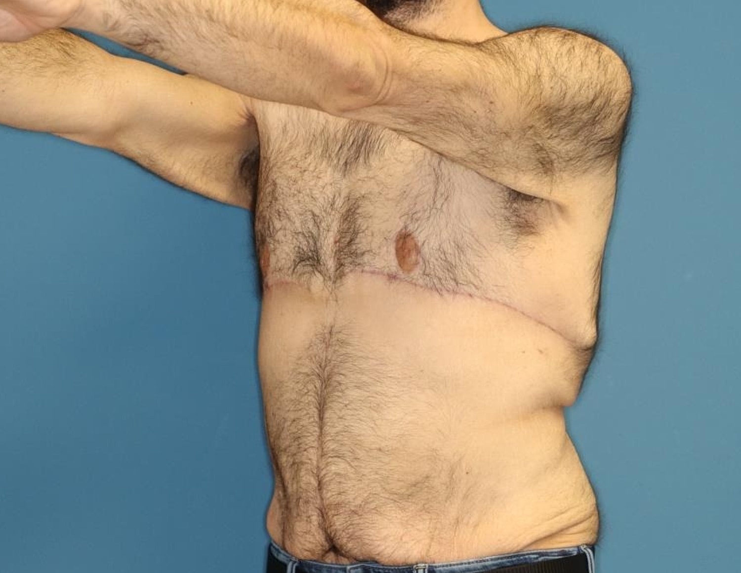 Gynecomastia Surgery Before & After