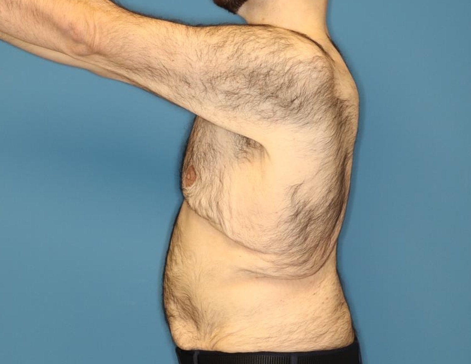 Gynecomastia Surgery Before & After