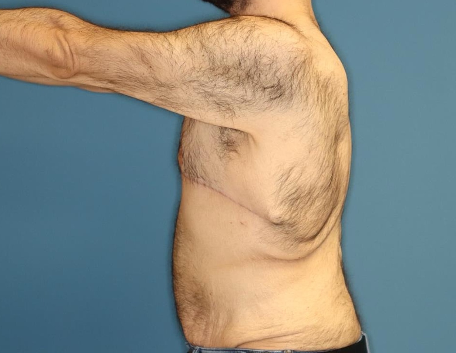 Gynecomastia Surgery Before & After