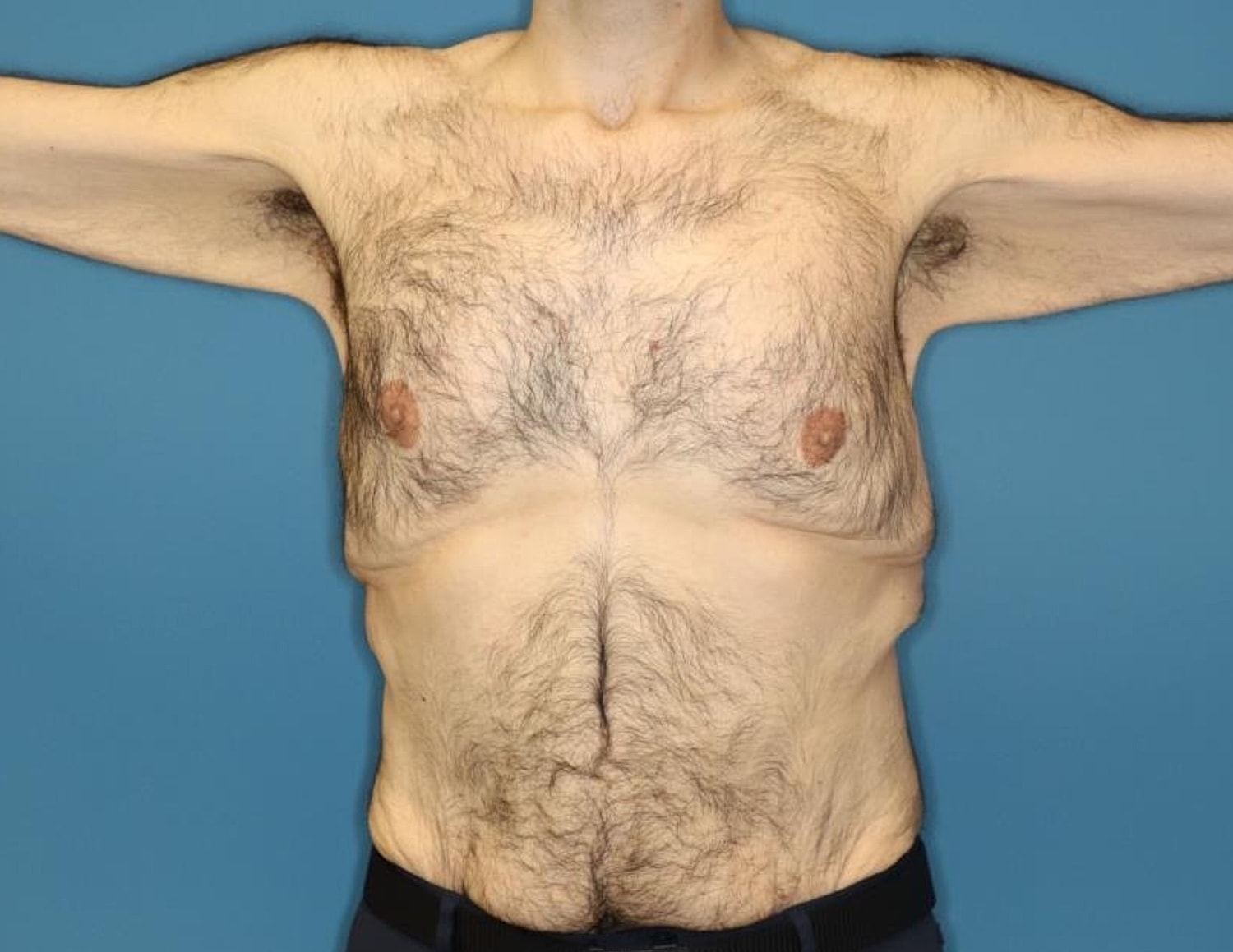 Gynecomastia Surgery Before & After