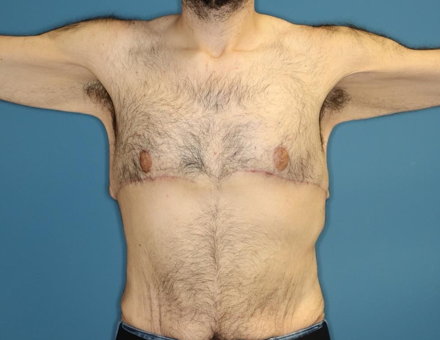 Gynecomastia Surgery Before & After