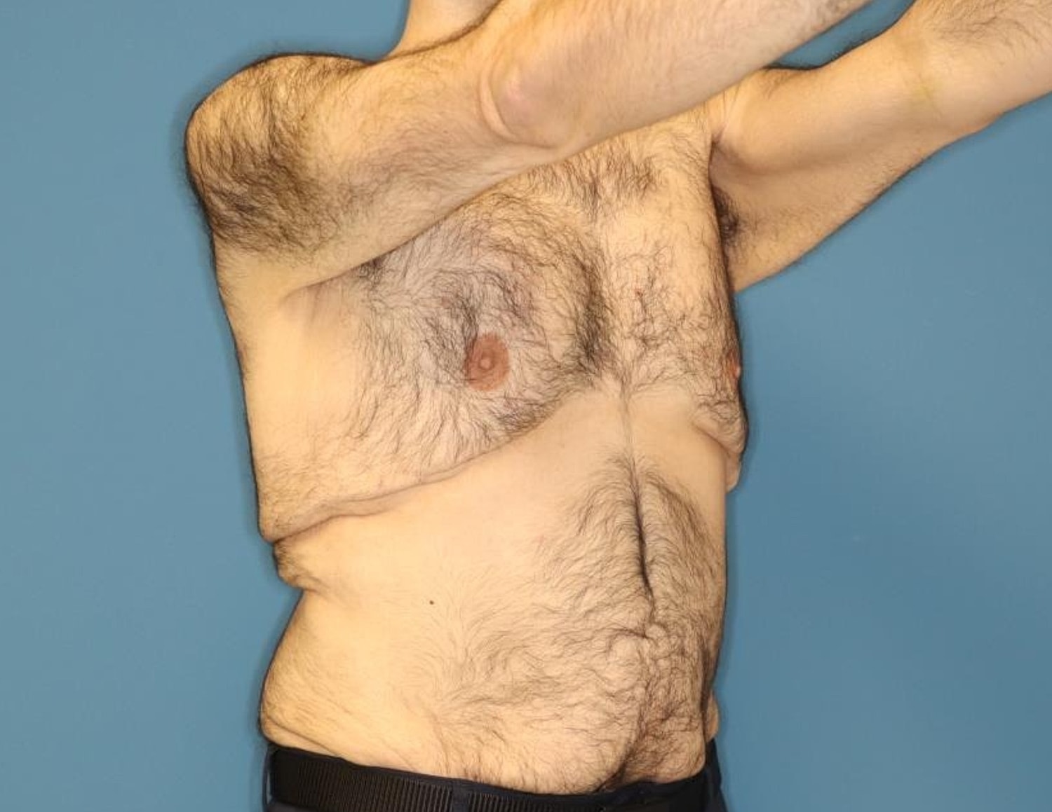 Gynecomastia Surgery Before & After