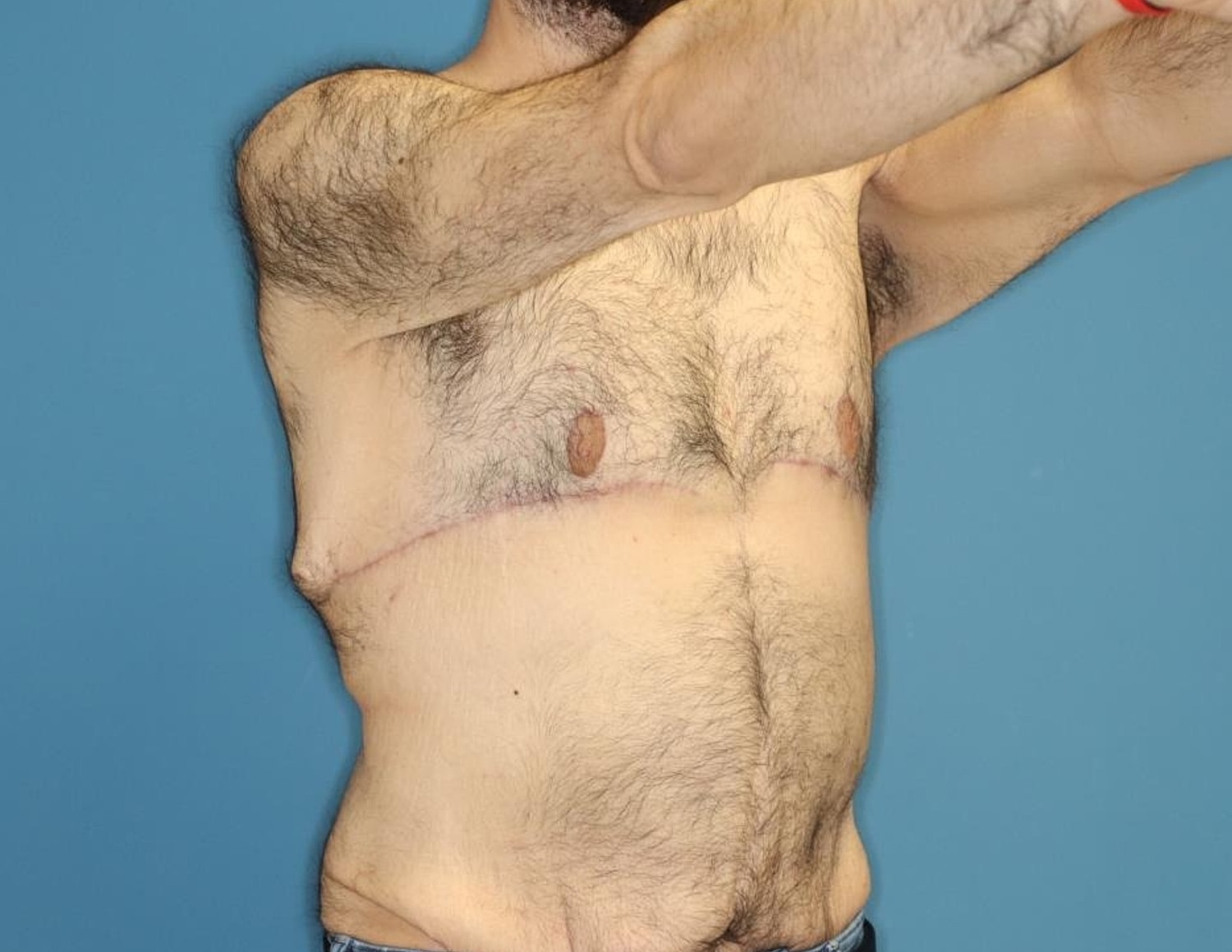Gynecomastia Surgery Before & After