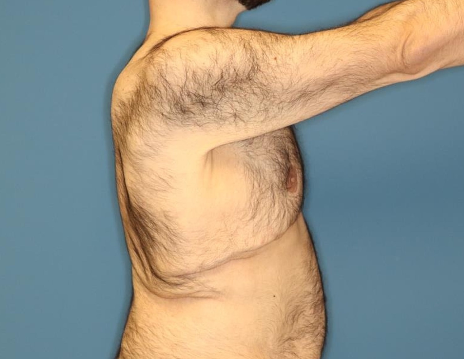 Gynecomastia Surgery Before & After